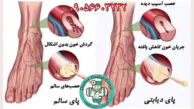 زخم دیابت جراحی لثه