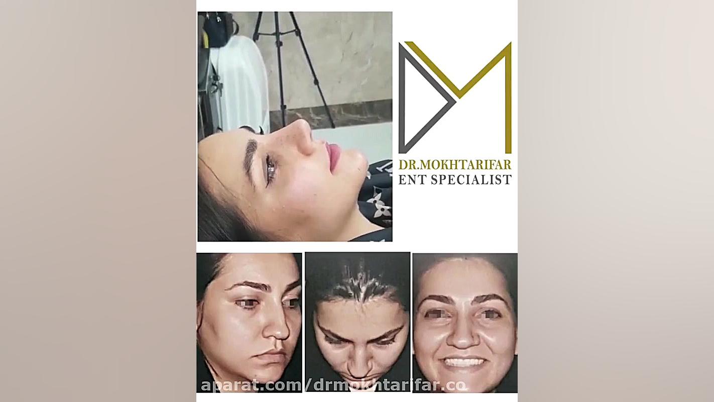 فیلم حدود سه هفته پس از جراحی زیبایی بینی گوشتی دکتر فاطمه مختاری فر جراح بینی در لرستان