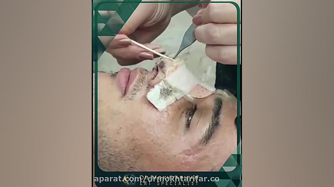 فیلم واقعی بلافاصله پس از برداشتن اسپلینت بینی دکتر فاطمه مختاری فر جراح بینی در لرستان