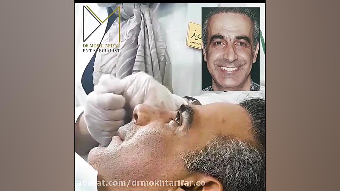 فیلم واقعی جراحی بینی گوشتی دکتر فاطمه مختاری فر جراح بینی در لرستان