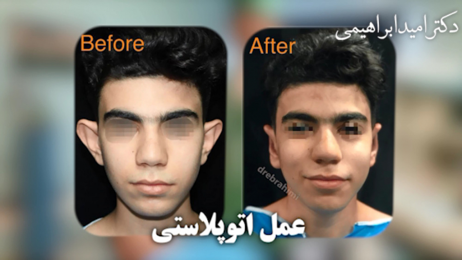 عمل اتوپلاستی توسط دکتر امید ابراهیمی دکتر امید ابراهیمی