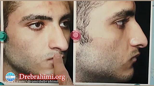 اصلاح افتادگی نوک بینی گوشتی توسط دکتر امید ابراهیمی بهترین جراح بینی در تهران دکتر امید ابراهیمی