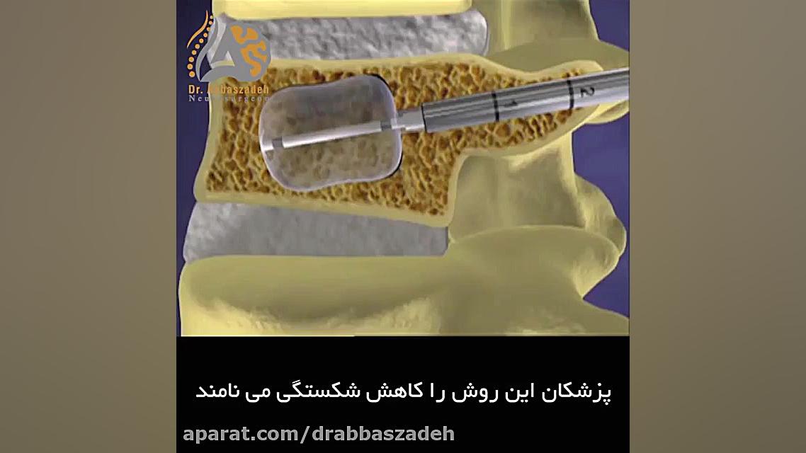 فیلم کوتاه از بهترین روش درمان شکستگی مهره ستون فقرات در بیماران با پوکی استخوان آر اف فرکشنال