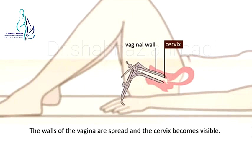 فیلم تست پاپ اسمیر دکتر شهناز احمدی