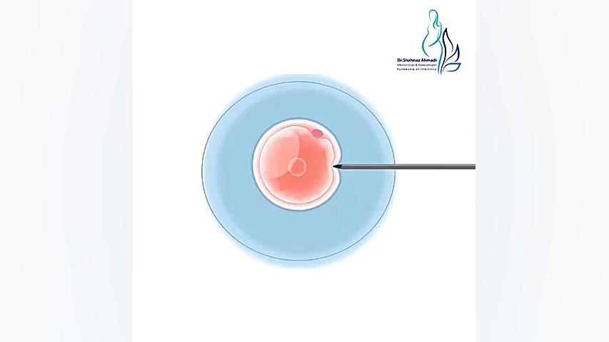 بارداری از طریق آی وی اف دکتر شهناز احمدی