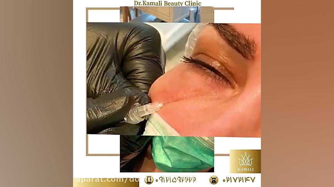 فیلم رفع تیرگی و چین و چروک دور چشم با کربوکسی تراپی دندان شیری