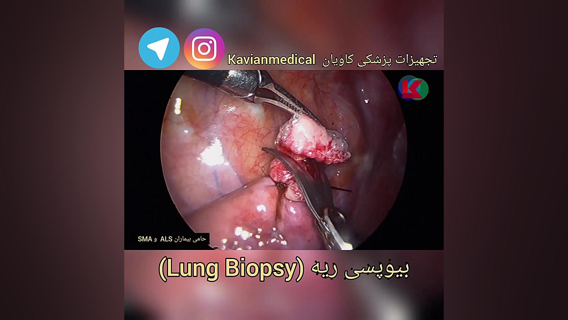 بیوپسی (نمونه برداری) از ریه Lung Biopsy تزریق چربی