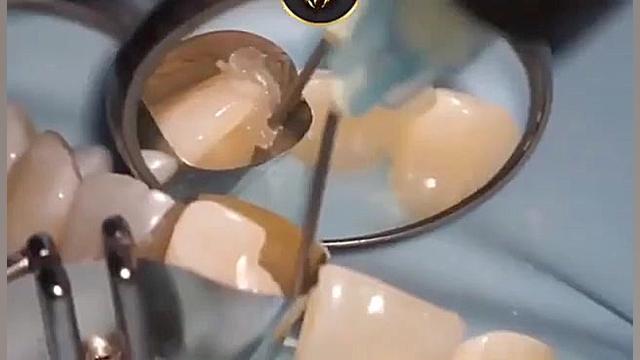 پر کردن دندان جلو اینجوری بلیچینگ