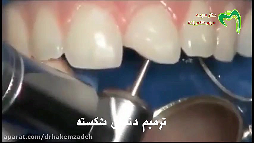 نحوه ترمیم دندان شکسته جراحی زیبایی پلک