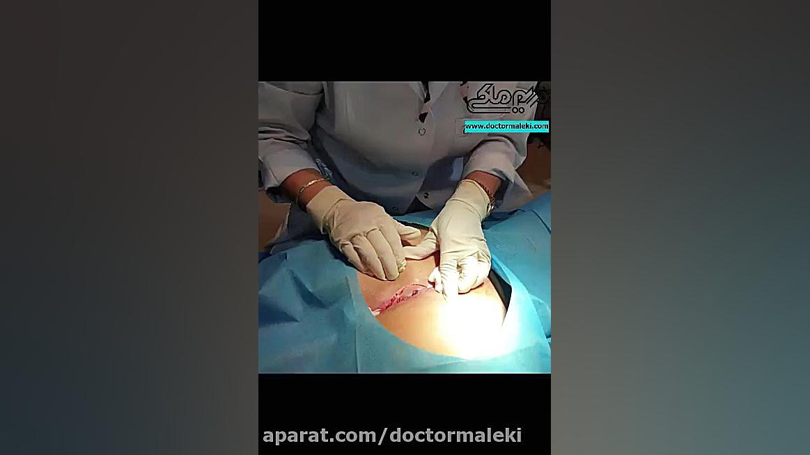 جراحی کیست مویی (PNS) دکتر مریم ملکی - کلینیک پوست و مو و زیبایی هور