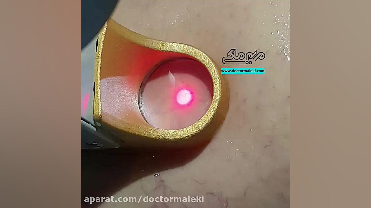 لیزر عروق خونی دکتر مریم ملکی - کلینیک پوست و مو و زیبایی هور