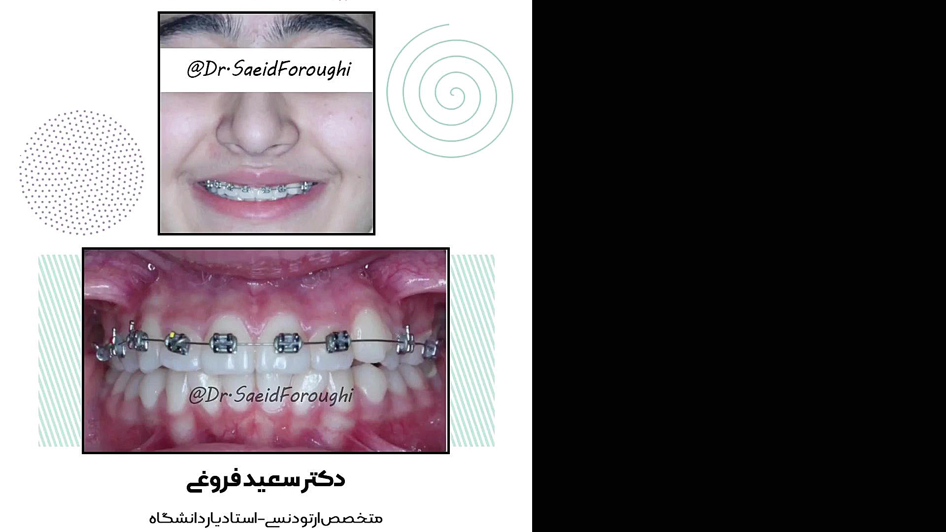 اصلاح بینظمی دندانها و عدم هماهنگی دندانهای دو فک باهم توسط ارتودنسی ثابت دکتر سعید فروغی متخصص ارتودنسی