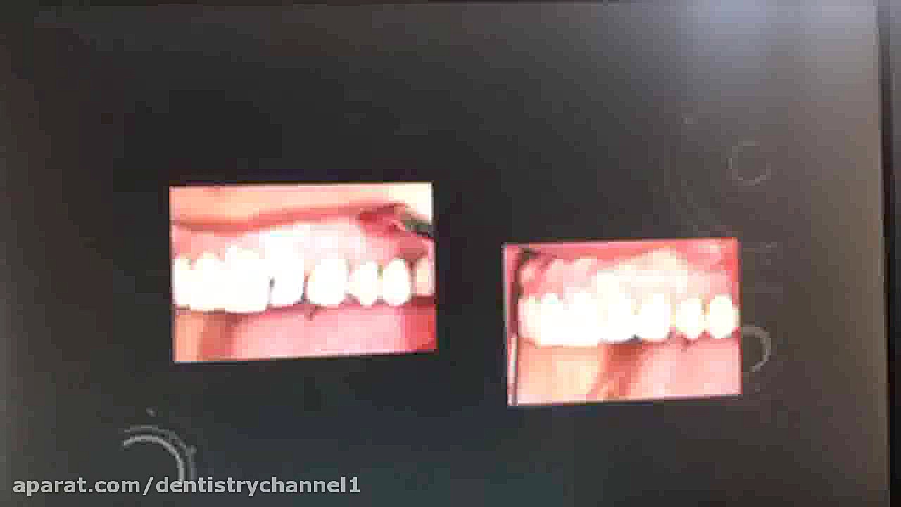 آناتومي و ترميم دندان هاي قدامي بخش سوم ( دکتر جمشيديان و دکتر نعمتي ) پوشش زخم هیدروکلوییدی