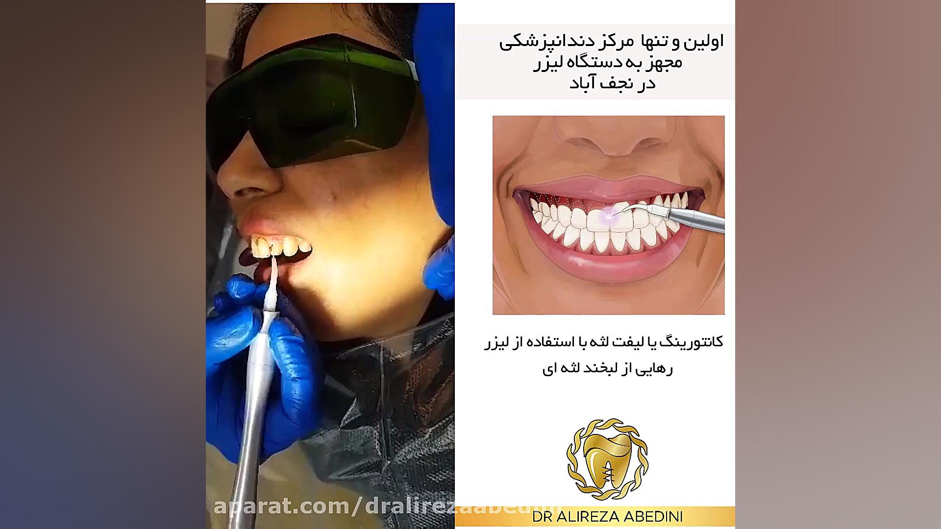 دکتر علیرضا عابدینی | دندانپزشک زیبایی اصفهان | لیفت لثه با لیزر کاشت مو