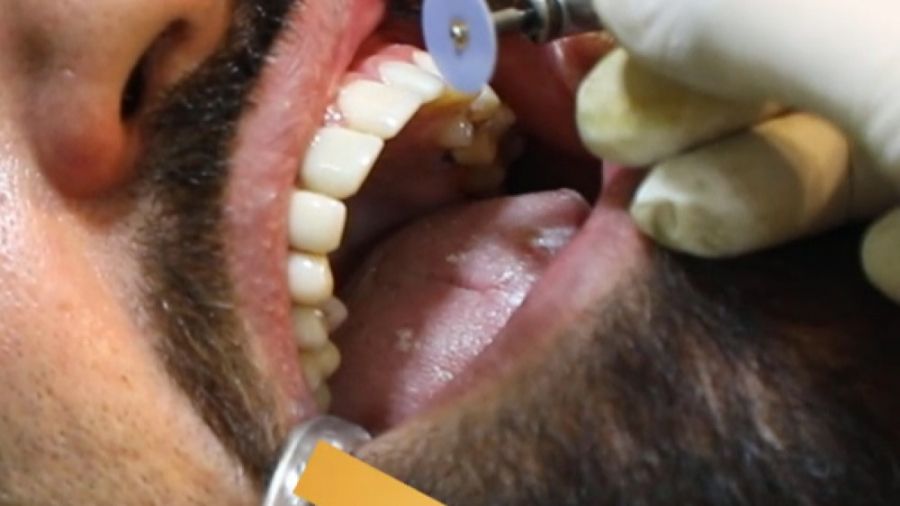 ونیر کامپوزیت در اصفهان | دندانپزشک زیبایی دکتر علیرضا عابدینی ANA