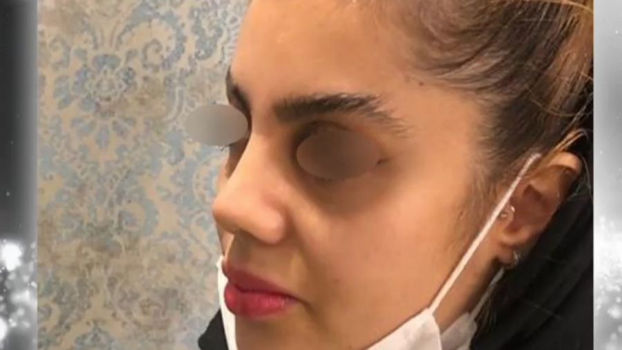 جراحی زیبایی بینی دکتر علی باقری حق