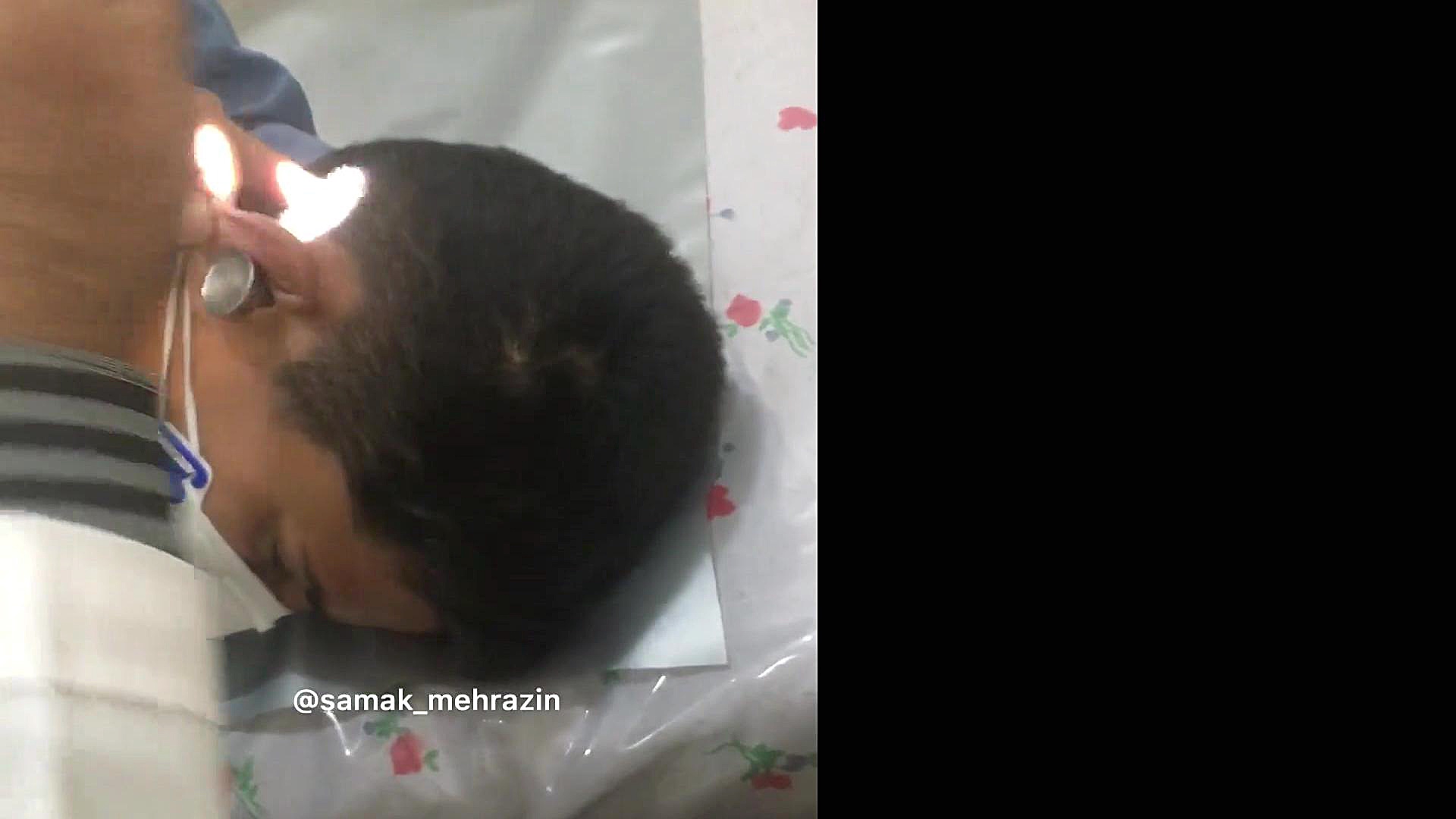 ساكشن گوش جراحی زیبایی پلک