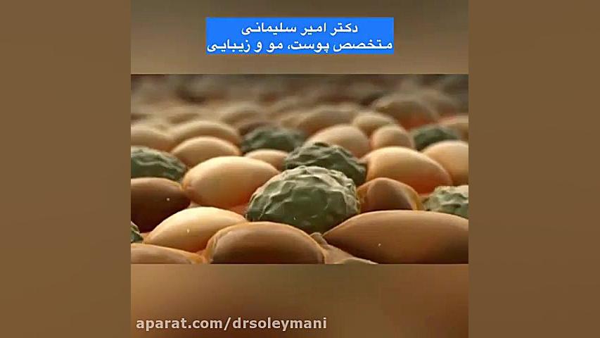 تاثیر آفتاب بر پوست دکتر امیر سلیمانی