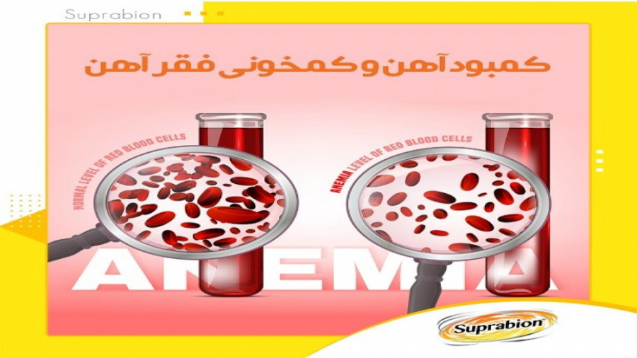 کمبود آهن و کم خونی فقر آهن چیست و چه عوارضی دارد؟ | سوپرابیون اتوپلاستی