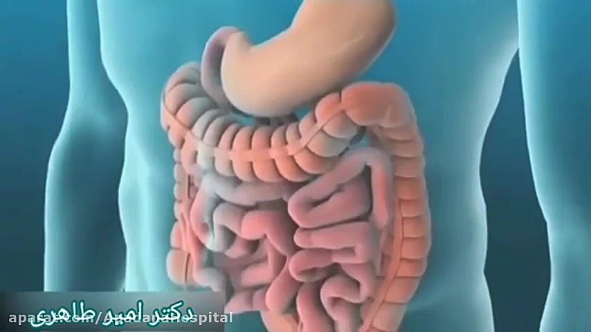 کولونوسکوپی چیست لمینت