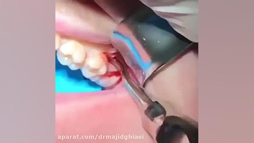 جراحی دندان-دکترمجیدقیاسی دکترمجیدقیاسی