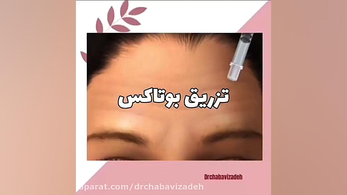 فیلم واقعی تزریق بوتاکس دکتر صفیه چعباوی زاده