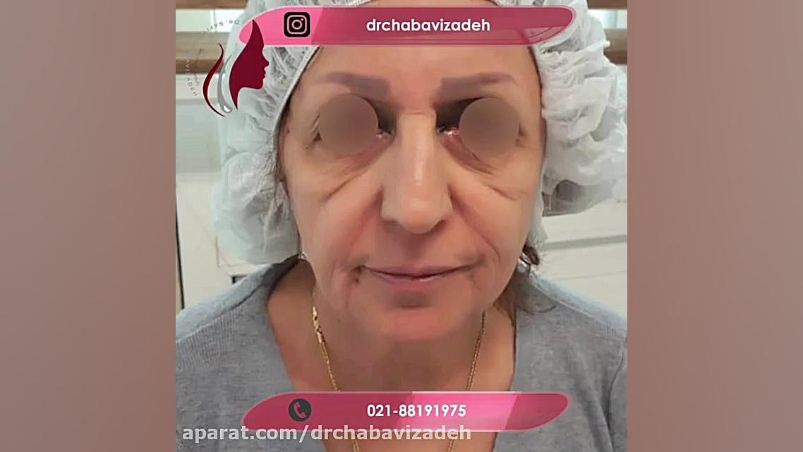 فیلم واقعی لیفت صورت با نخ پلاسماجت