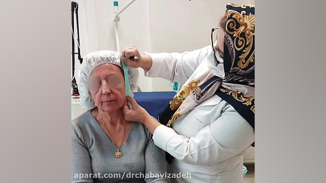 فیلم واقعی لیفت صورت با نخ - پارت اول: آماده سازی نخ کلاژن ساز دکتر صفیه چعباوی زاده