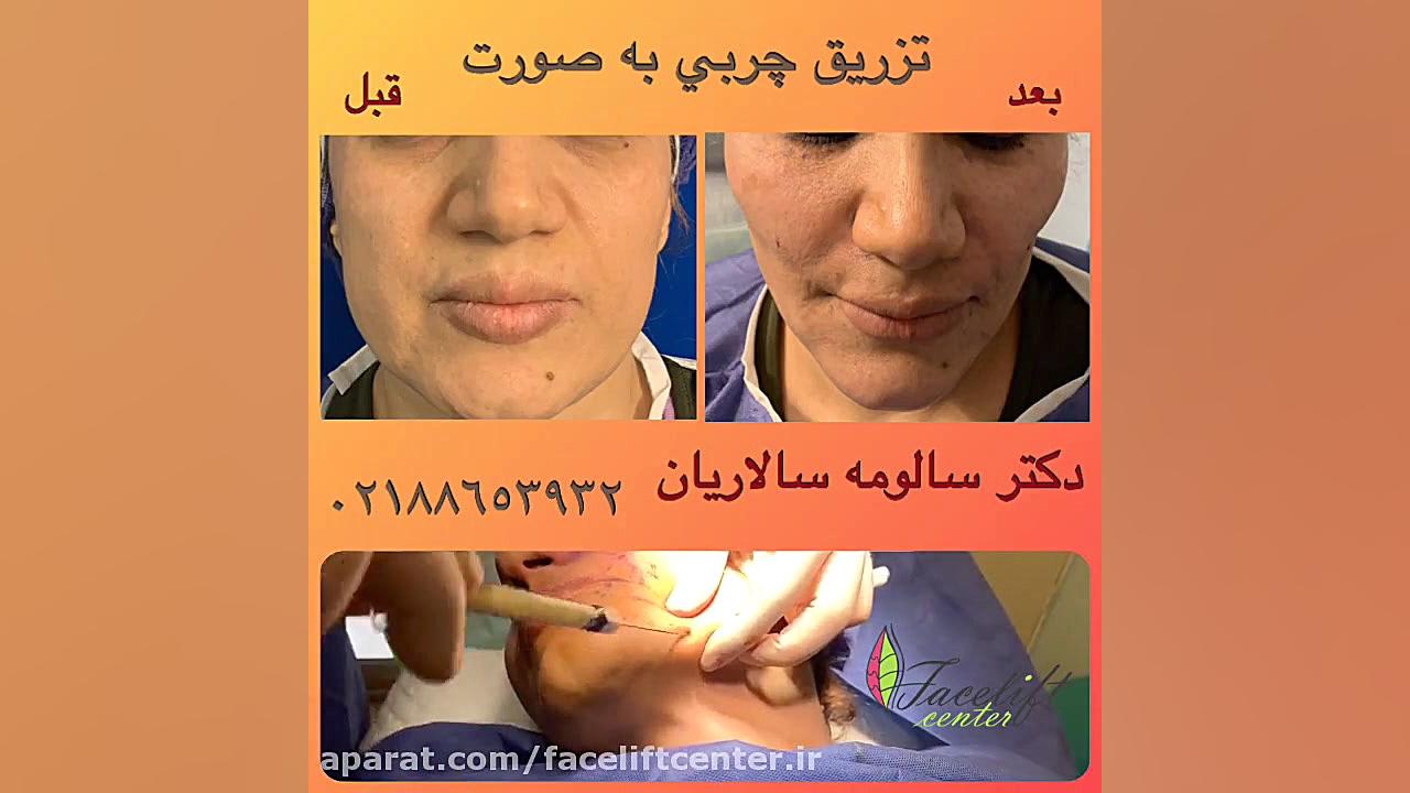 فیلم تزریق چربی به صورت بیماری آلبومینوری وراثتی