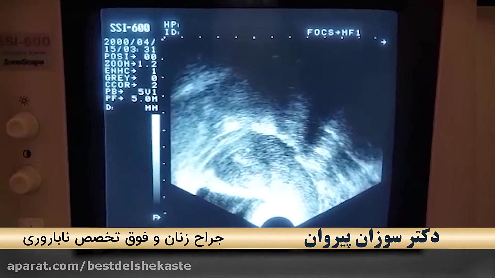 سونوگرافی تخمدان پلی کیستیک مزوتراپی