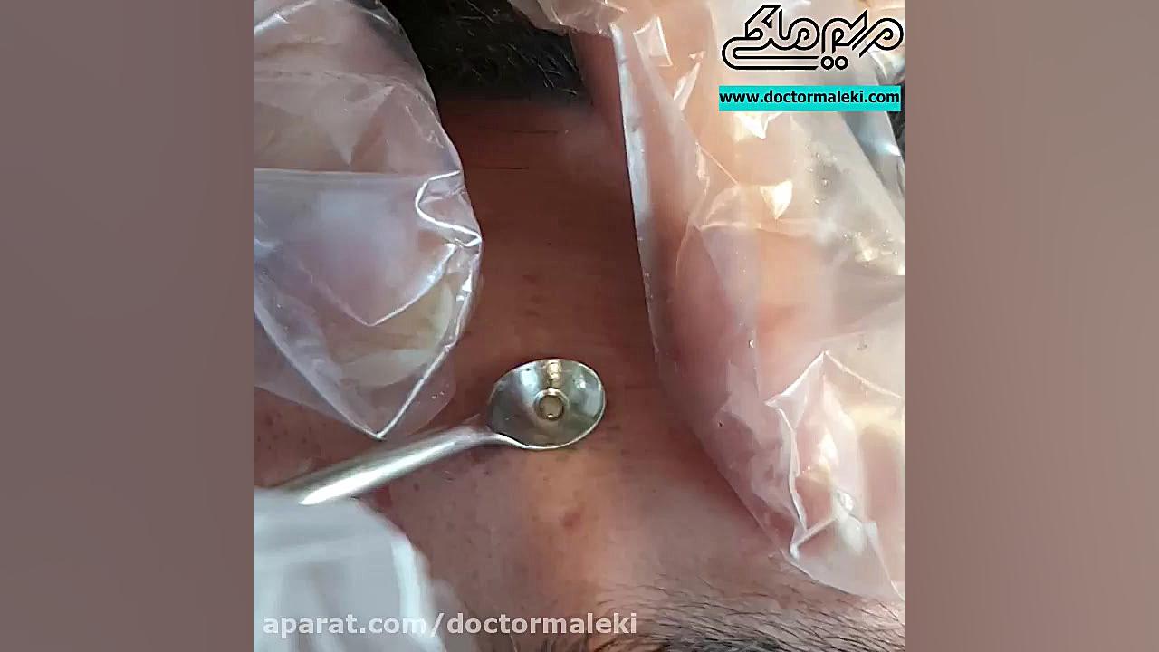 تخلیه جوش زیرپوستی دکتر مریم ملکی - کلینیک پوست و مو و زیبایی هور