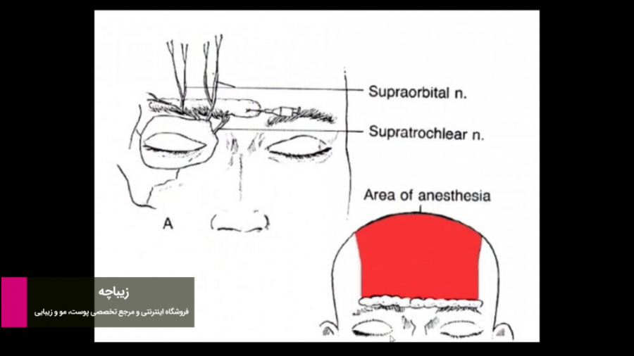نحوه بلوک عصب سوپرا اربیتال (Supra Orbital) لیپوماتیک