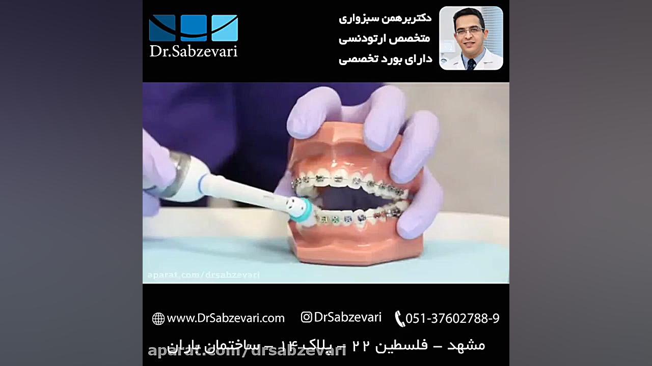 کاربرد مسواک برقی در ارتودنسی ثابت _ بخش دوم دکتر برهمن سبزواری - متخصص ارتودنسی - مشهد