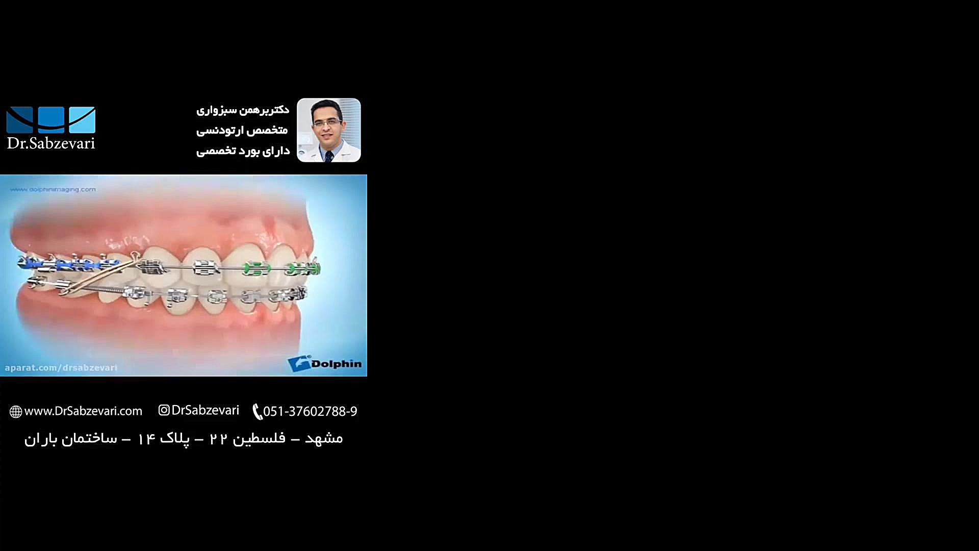 اجزای دستگاه ارتودنسی ثابت دکتر برهمن سبزواری - متخصص ارتودنسی - مشهد