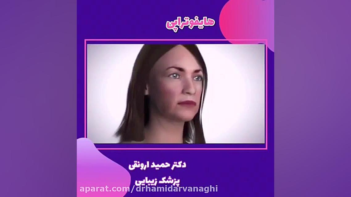 معجزه جوانسازی با هایفوتراپی کاپوت سکودانئوم