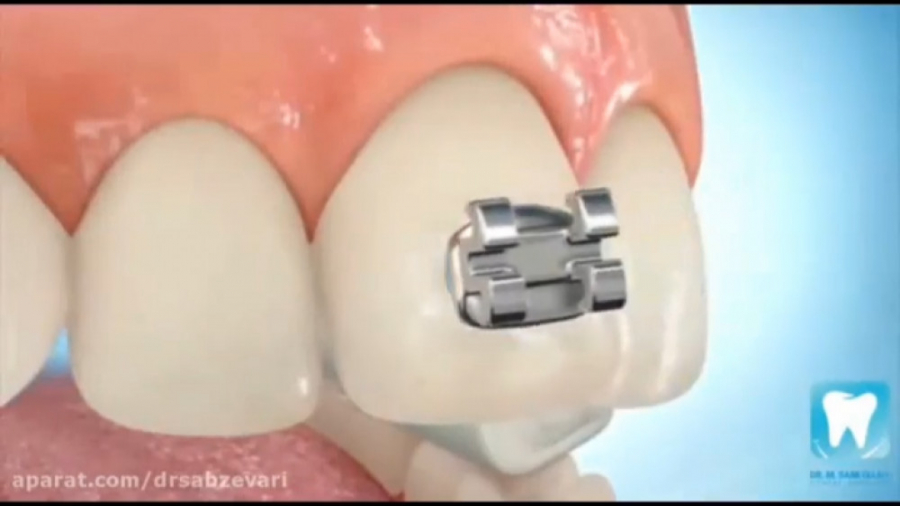 مراحل ارتودنسی ثابت و نگهدارنده دکتر برهمن سبزواری - متخصص ارتودنسی - مشهد