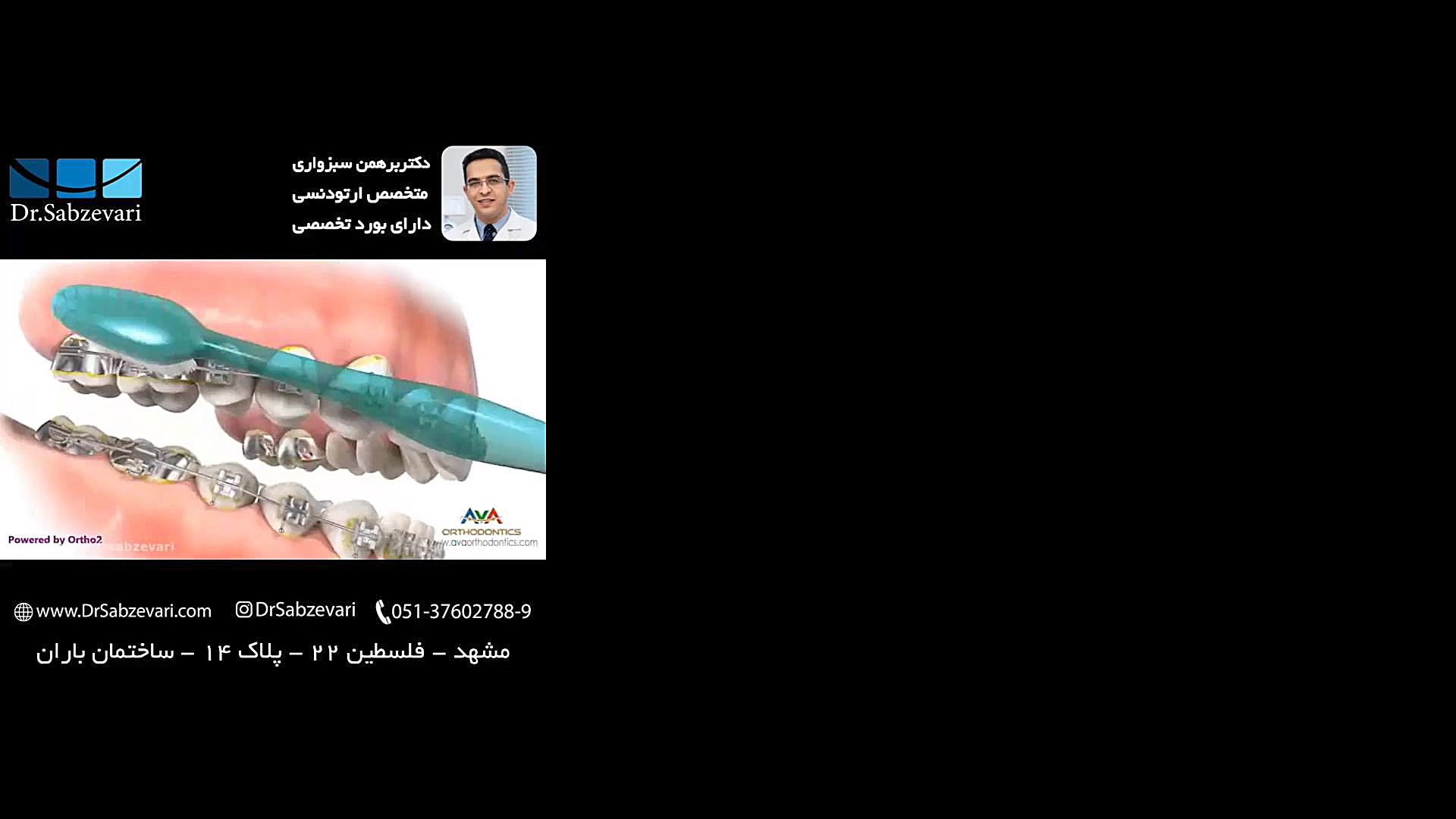مراحل بهداشت دهان در ارتودنسی ثابت دکتر برهمن سبزواری - متخصص ارتودنسی - مشهد
