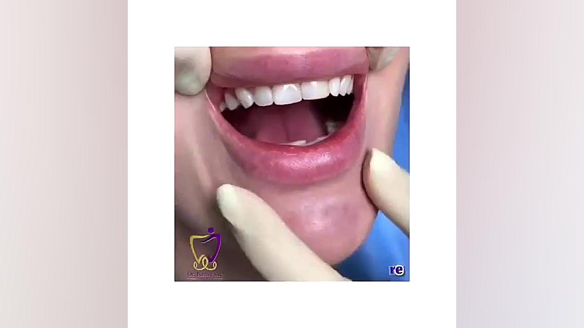 انجام کار های زیبایی مراجعه کننده عزیز مون دکتر ندا هادی-دندانپزشک زیبایی
