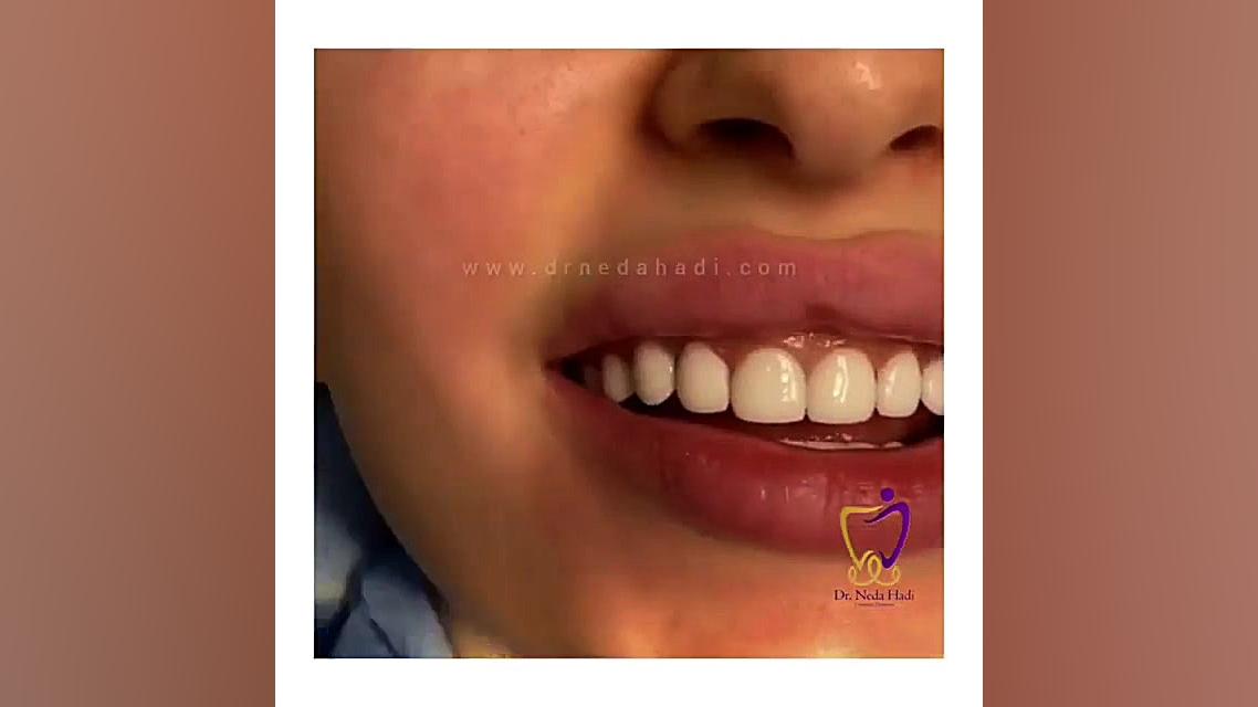لبخند جذاب شما دکتر ندا هادی-دندانپزشک زیبایی