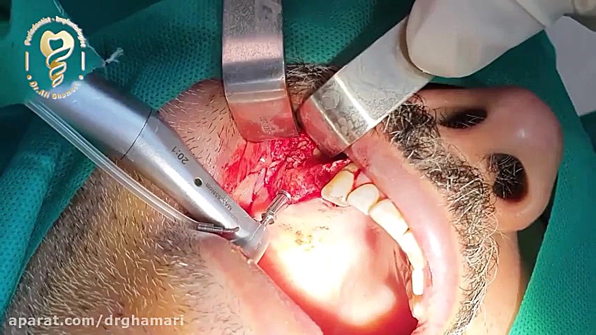 فیلم واقعی جراحی سینوس لیفت باز دکتر علی قمری - متخصص جراحی لثه و ایمپلنت