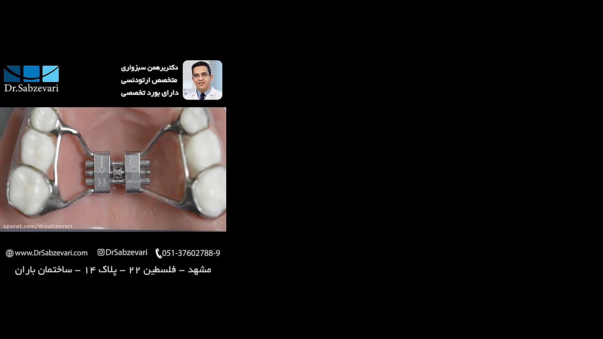 کاربرد پیچ مخصوص در فک بالا یا پایین برای افزایش عرض فک دکتر برهمن سبزواری - متخصص ارتودنسی - مشهد