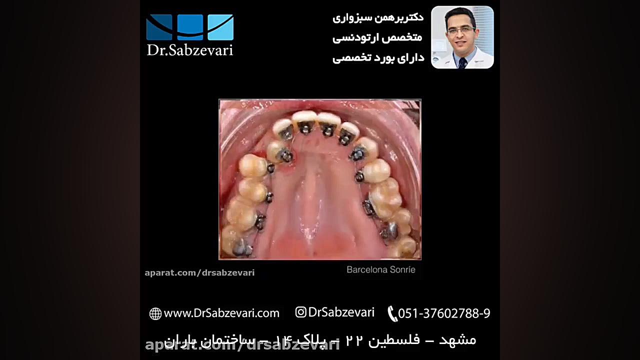 ارتودنسی لینگوال (زبانی) دکتر برهمن سبزواری - متخصص ارتودنسی - مشهد