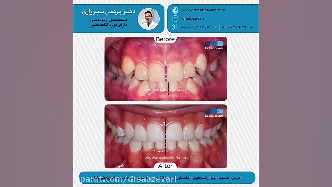 ارتودنسی ثابت با کشیدن چهار دندان آسیای کوچک در فک بالا و فک پایین دکتر برهمن سبزواری - متخصص ارتودنسی - مشهد