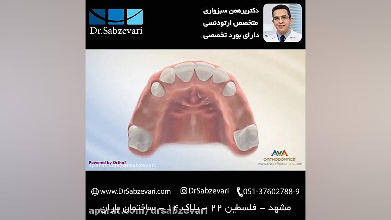 فضانگهدار در دوره دندانی مختلط - بخش اول دکتر برهمن سبزواری - متخصص ارتودنسی - مشهد