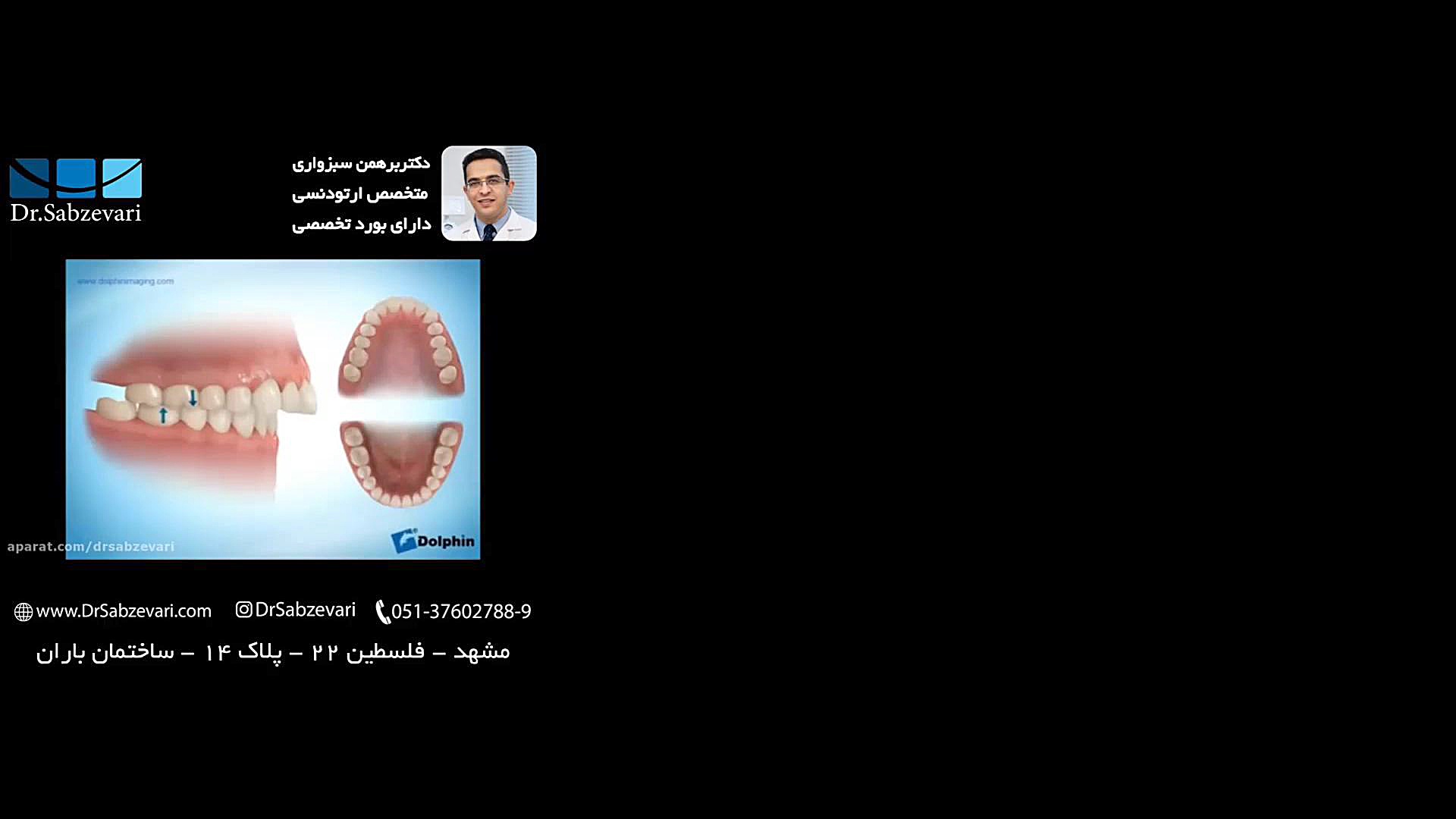 درمان کوچکی فک پایین با ارتودنسی ثابت و متحرک دکتر برهمن سبزواری - متخصص ارتودنسی - مشهد