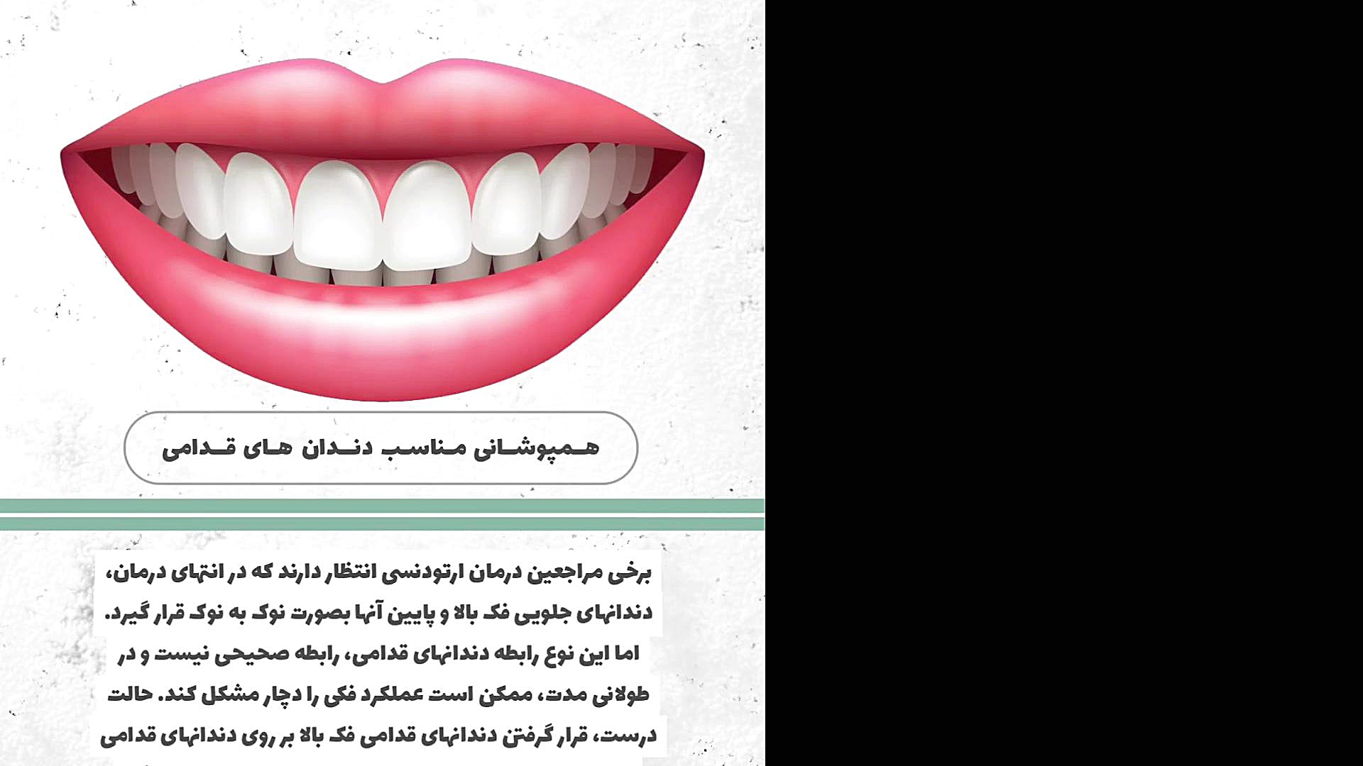 همپوشانی مناسب دندان های قدامی دکتر سعید فروغی متخصص ارتودنسی