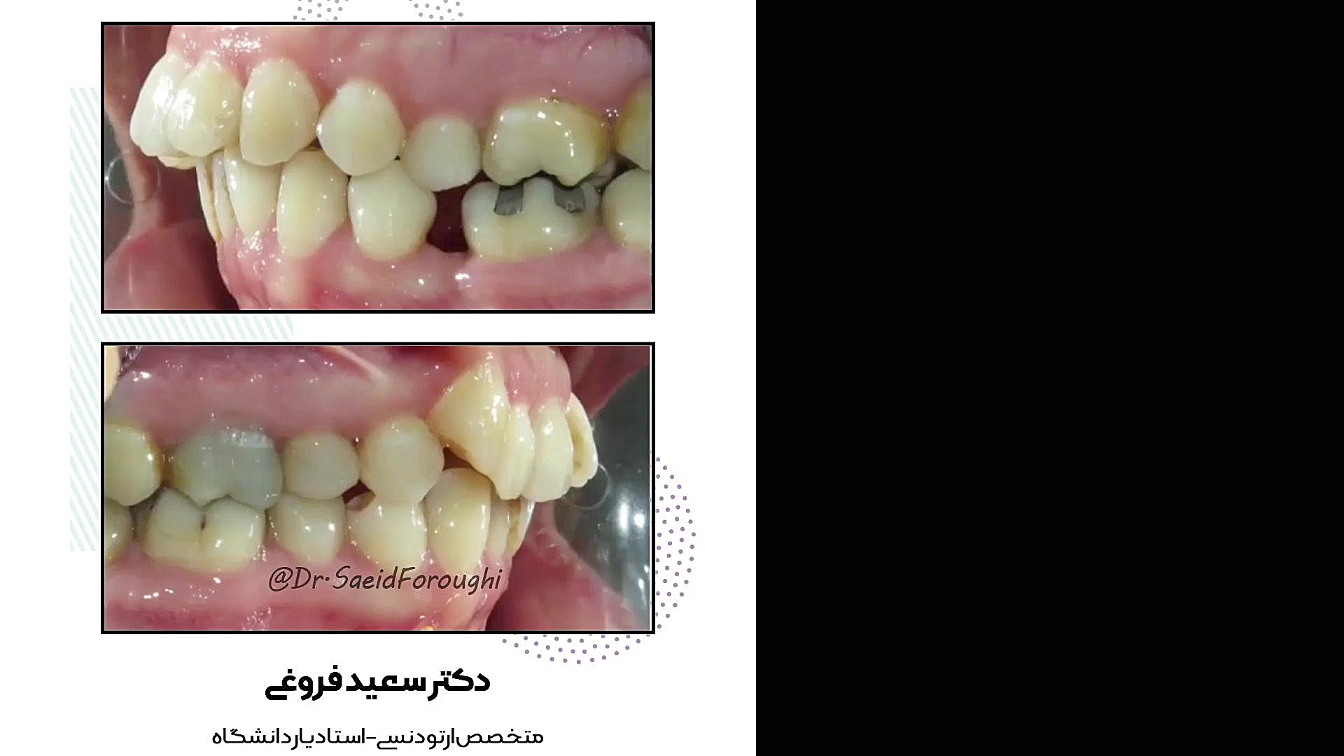 تصحیح بی نظمی و بیرون زدگی دندانهای فک بالا دکتر سعید فروغی متخصص ارتودنسی