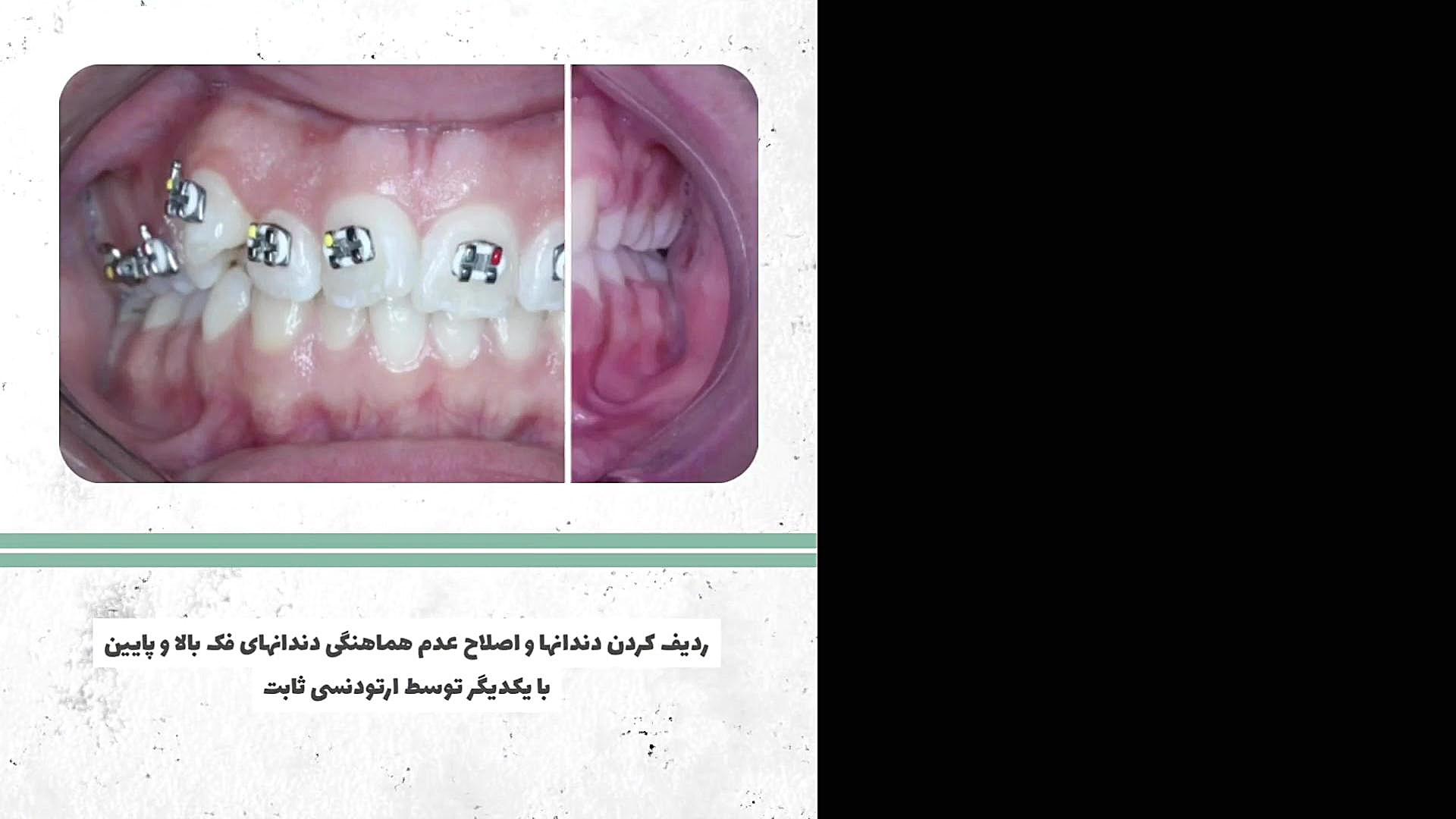 ردیف کردن دندانها و اصلاح عدم هماهنگی دندانهای فک بالا و پایین با یکدیگر توسط ار دکتر سعید فروغی متخصص ارتودنسی