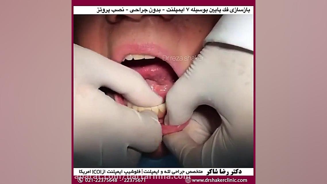 دندان مصنوعی با پایه ایمپلنت - دکتر رضا شاکر ماستوسیتوز