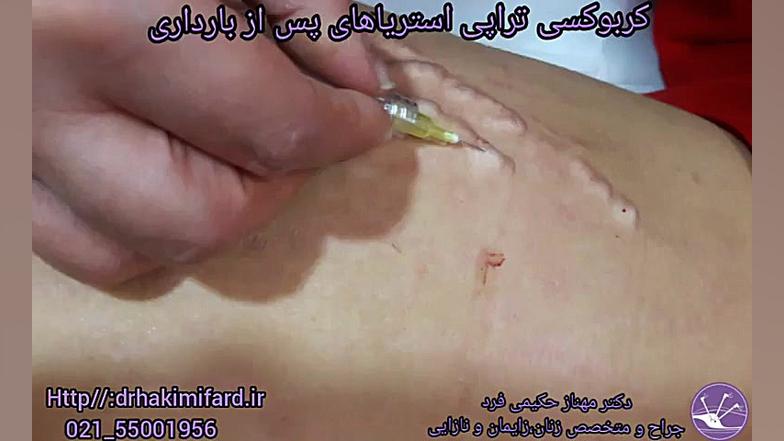 کربوکسی تراپی کلینیک دندانپزشکیایمونولوژی پیوند